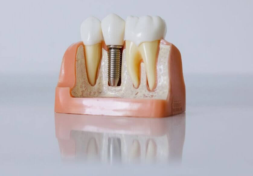 Guida alla scelta dei migliori impianti dentali